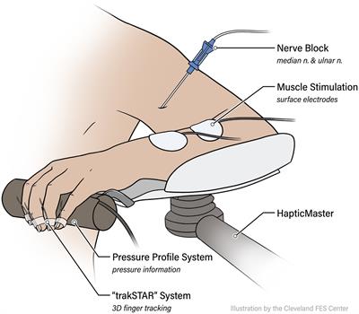 Peripheral nerve blocks of wrist and finger flexors can increase hand opening in chronic hemiparetic stroke